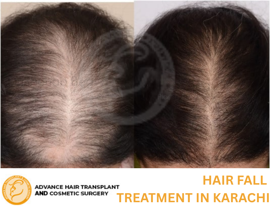 Hair Fall Treatment in Karachi