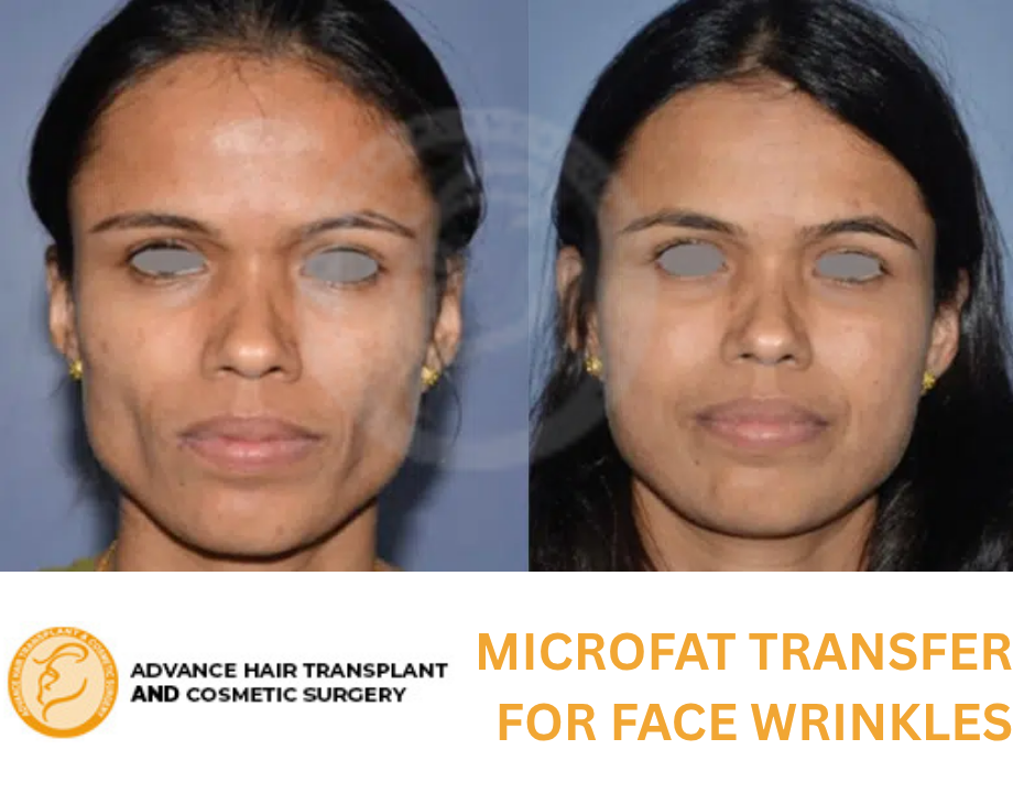 Microfat Transfer for Face Wrinkles